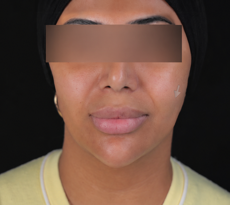 Before treatment